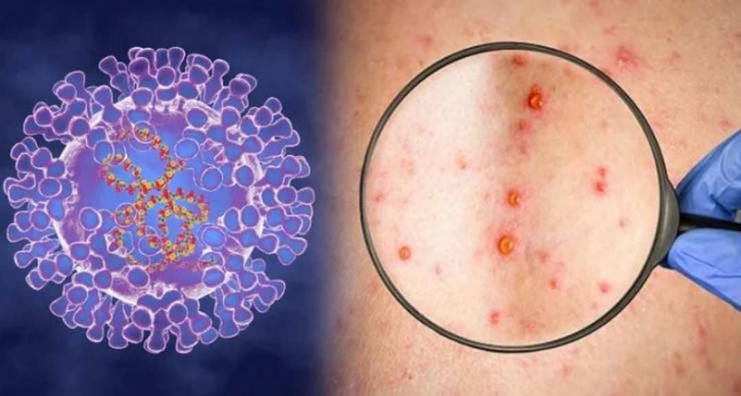 Virus đậu mùa khỉ là nguyên nhân gây ra bệnh