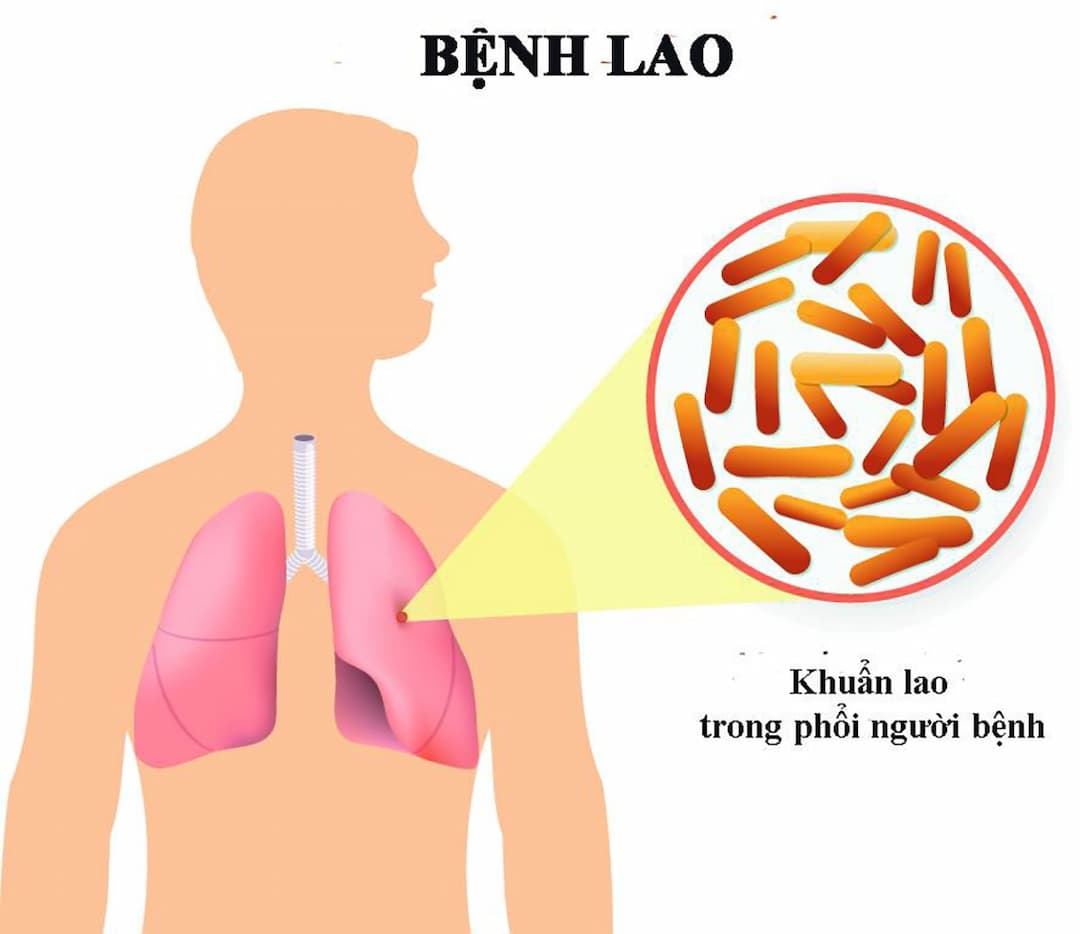 Các Triệu Chứng Của Bệnh Lao